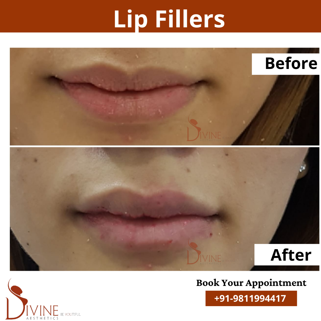 lip filler before after