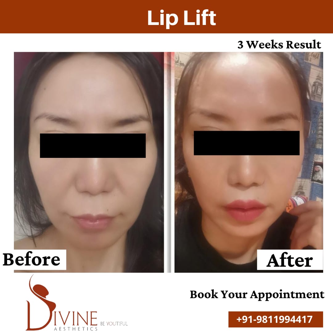 Lip Lift before after 2 March 2022