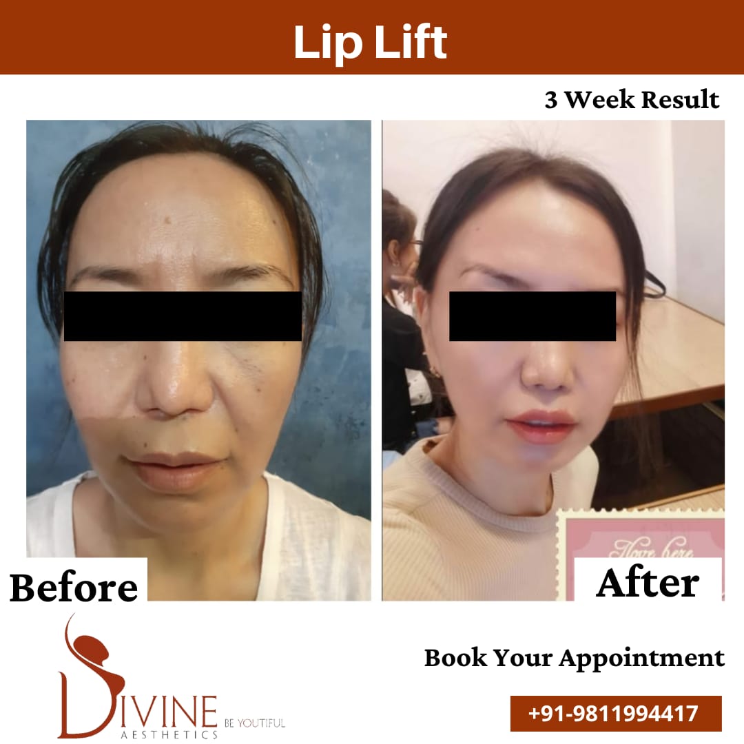 Lip Lift before after 1 Feb 2022