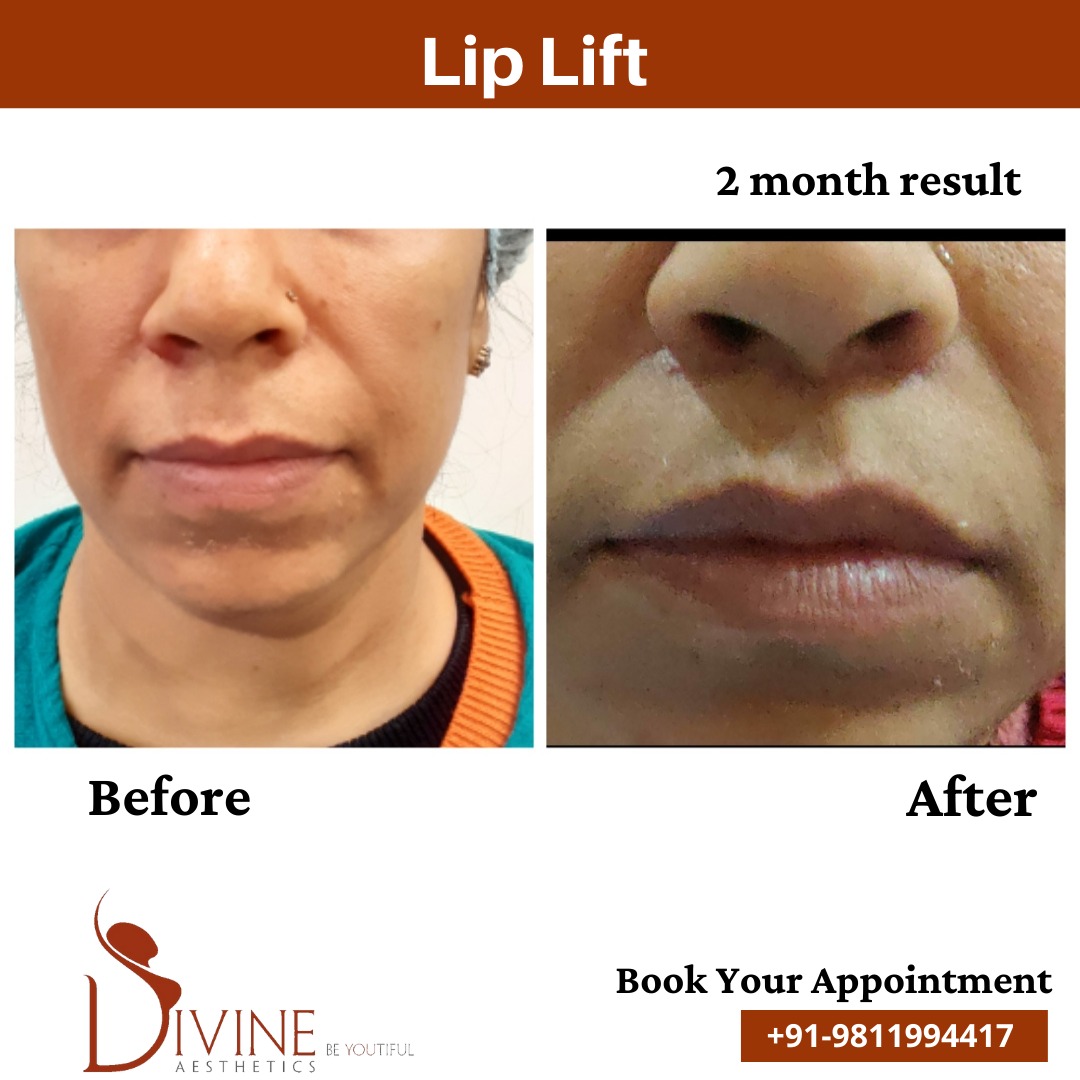 Lip Lift before after 1 March 2022
