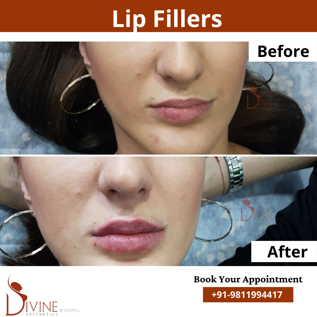 Lip Surgery before after result