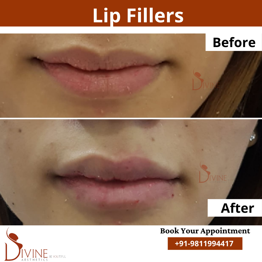 Lip Surgery before after