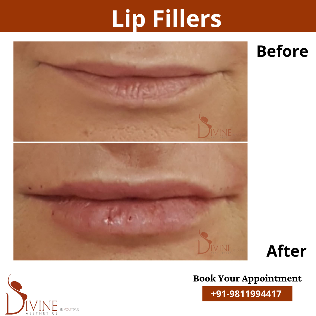 lips filler before after