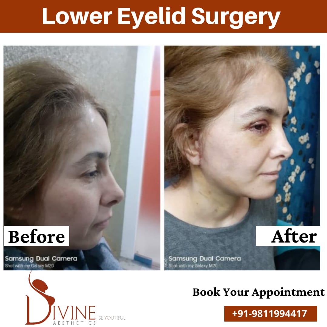 Lower Eyelid Surgery Before After