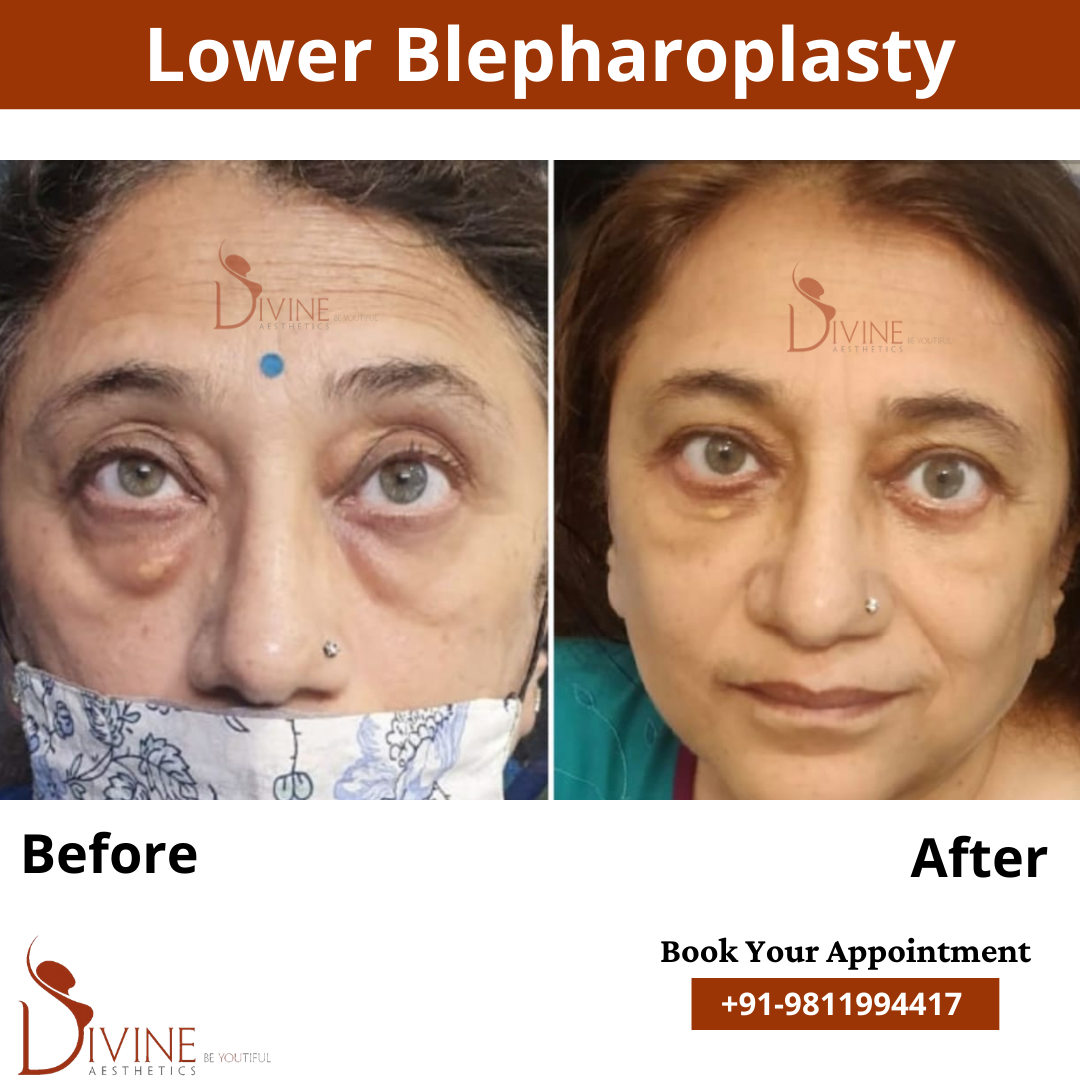 Lower blepharoplasty before after by dr amit gupta