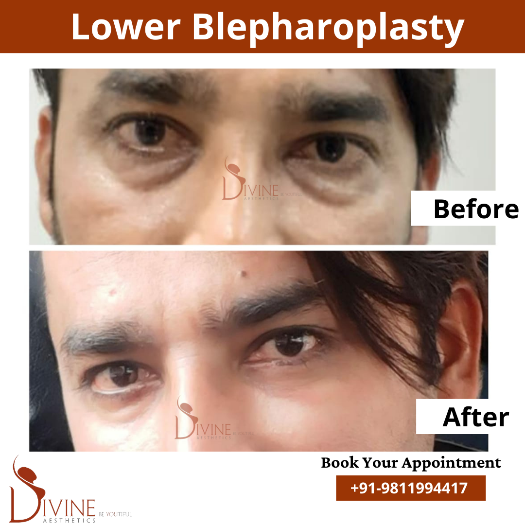 Lower blepharoplasty before after