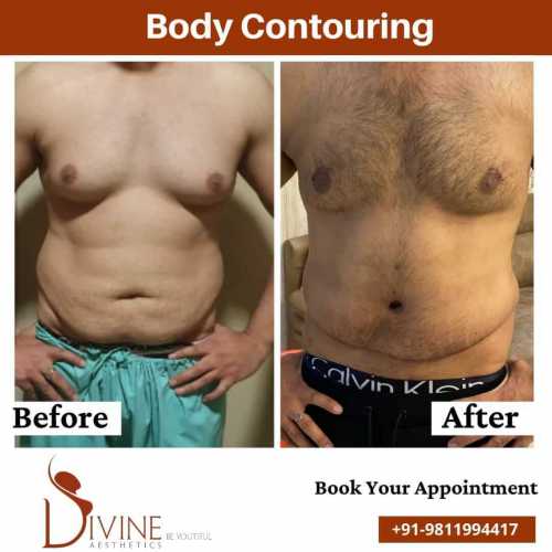 Male Body Contouring before after result