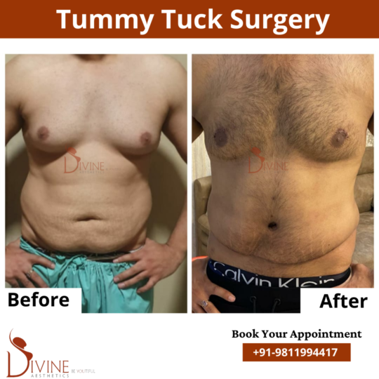 Male tummy Tuck front before after