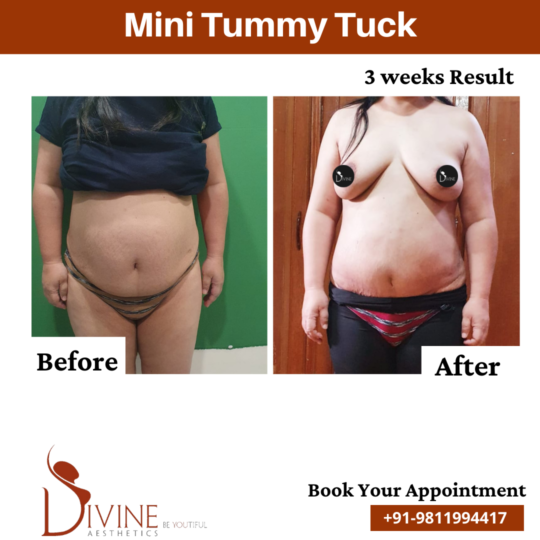 Mini Tummy Tuck result 2
