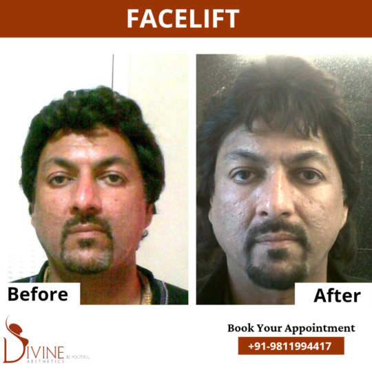 Mini facelift before After
