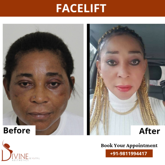 Mini facelift before After results