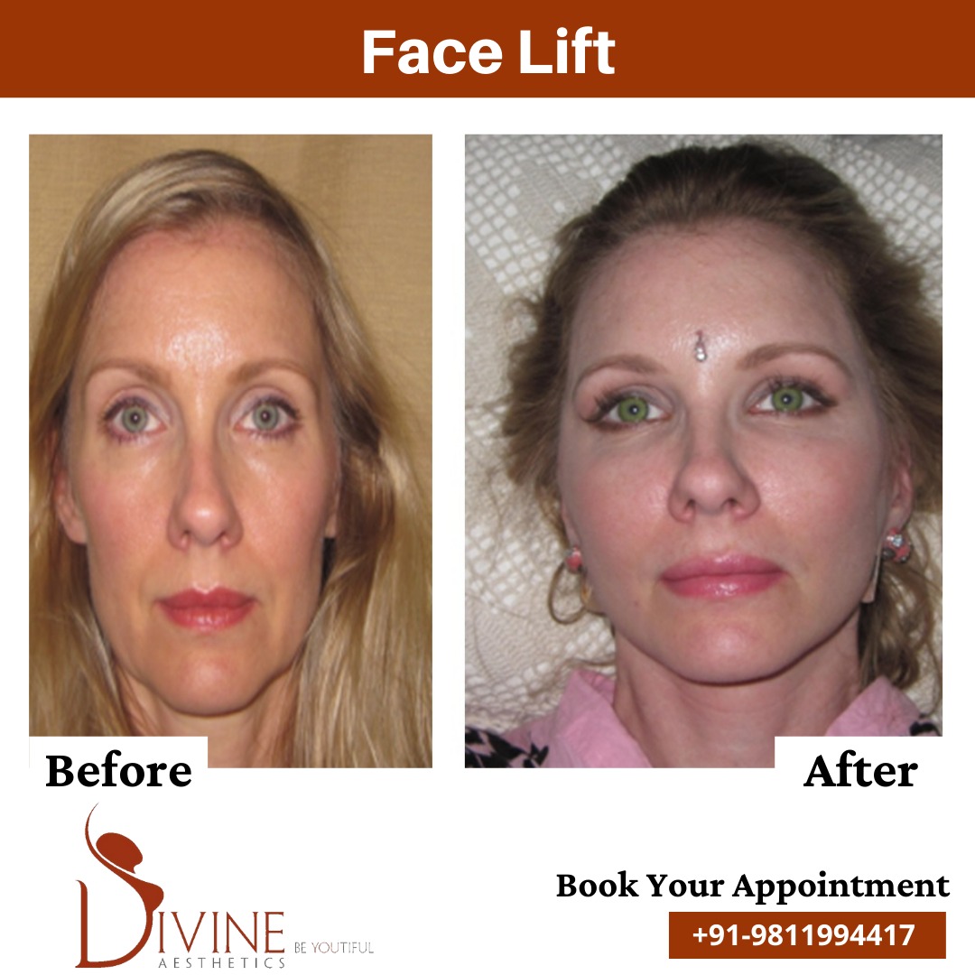 Mini facelift before - After