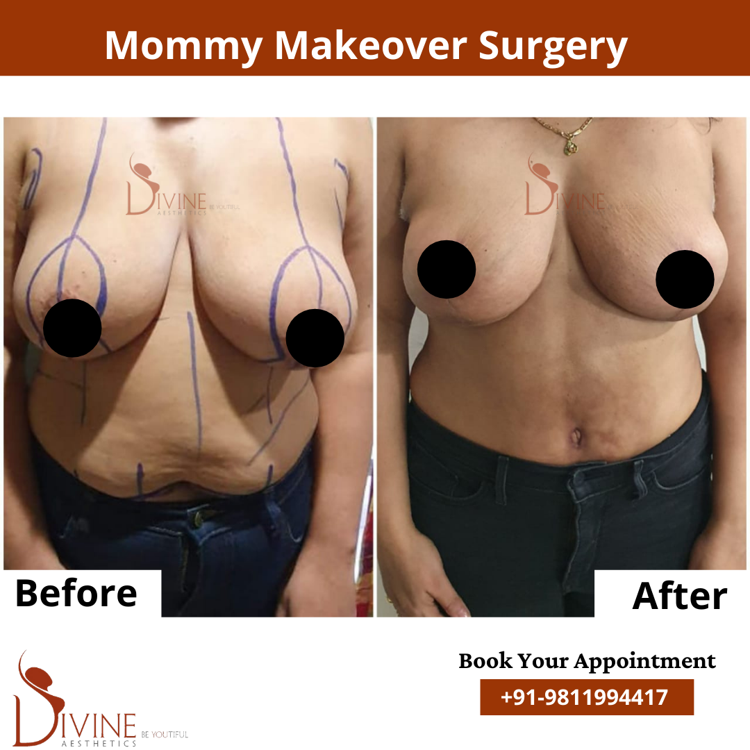 Mommy Makeover Before After results