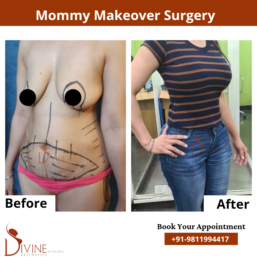 Mommy Makeover Before After