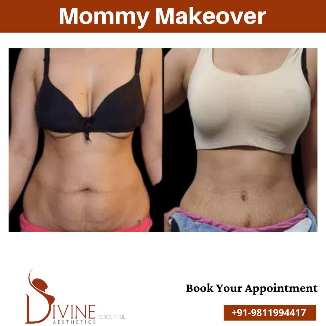 Mommy makeover before after results 1