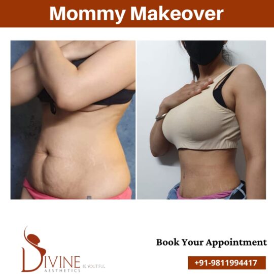 Mommy makeover before after results 2