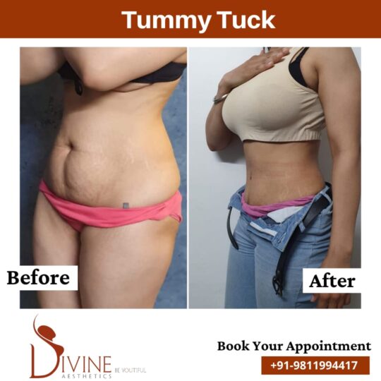 Side Tummy Tuck Before After Results