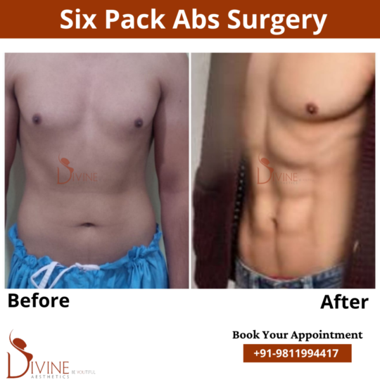 Six Pack Abs before after by Dr. Amit Gupta