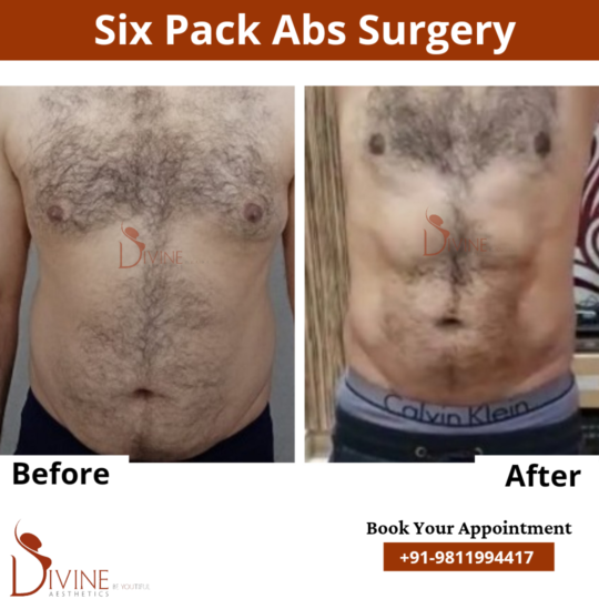 Six Pack Abs Before and After