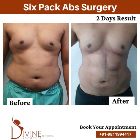 Six Pack Abs before after by Dr. Amit Gupta