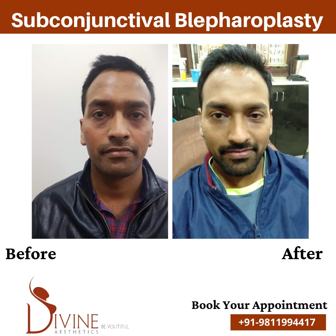 Subconjunctival Blepharoplasty Before After