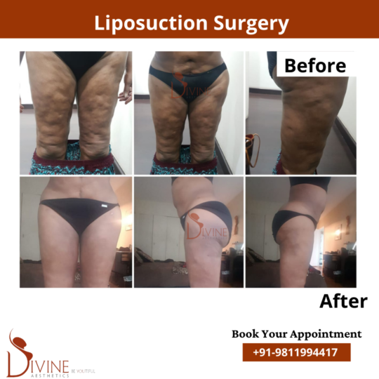 Thigh Liposuction Before After Results