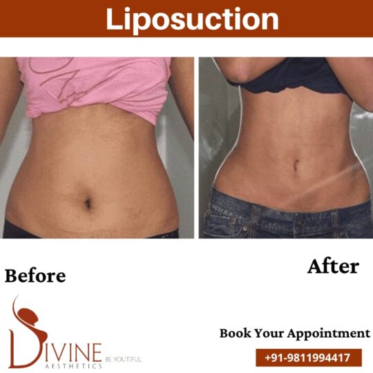 Tummy Liposuction before after