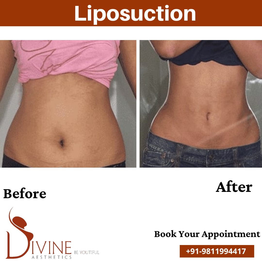 Tummy Liposuction Surgery by Divine Cosmetic Surgery