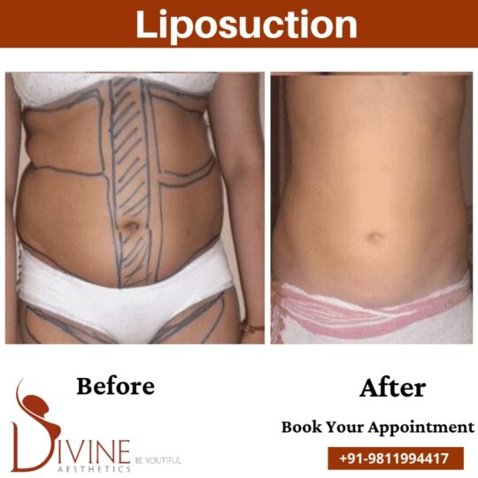 Tummy Liposuction before after image