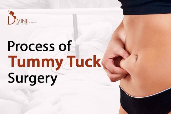 tummy tuck surgery process