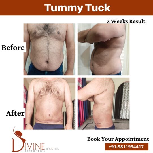 Tummy Tuck before after 1 March 2022