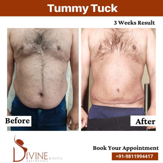Male Tummy Tuck before after