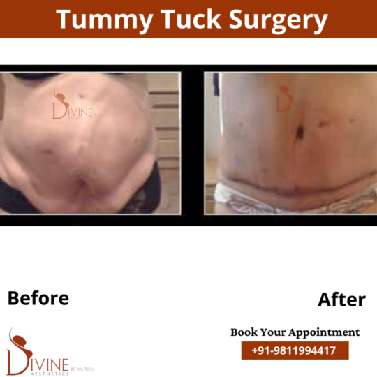 Tummy Tuck by Divine Cosmetic Surgery
