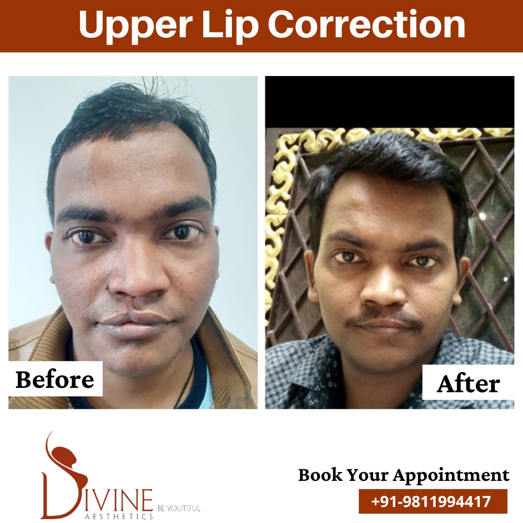 Upper Lip Correction Before After