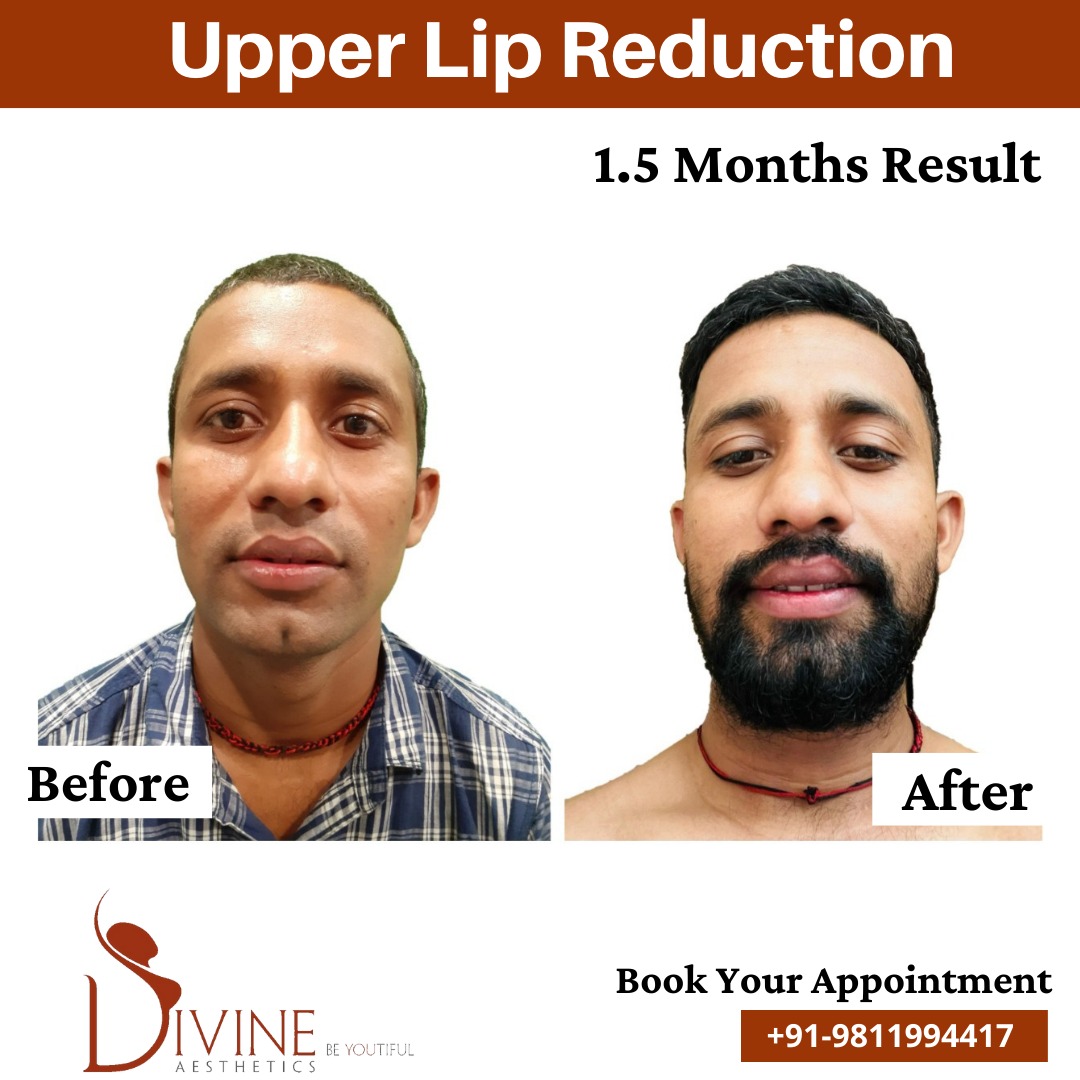 Upper Lip Reduction Before After