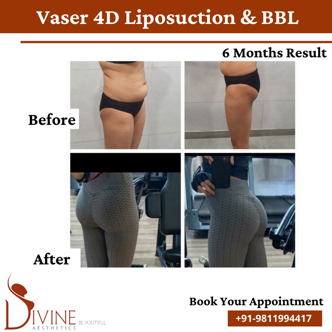 Vaser 4-D Liposuction & BBL