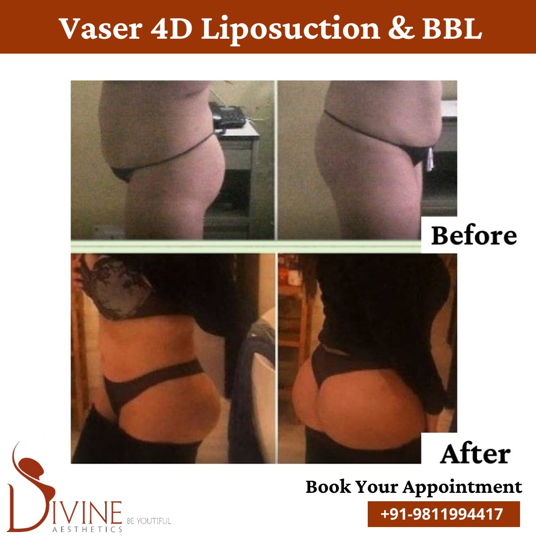 Vaser 4-D Liposuction & BBL