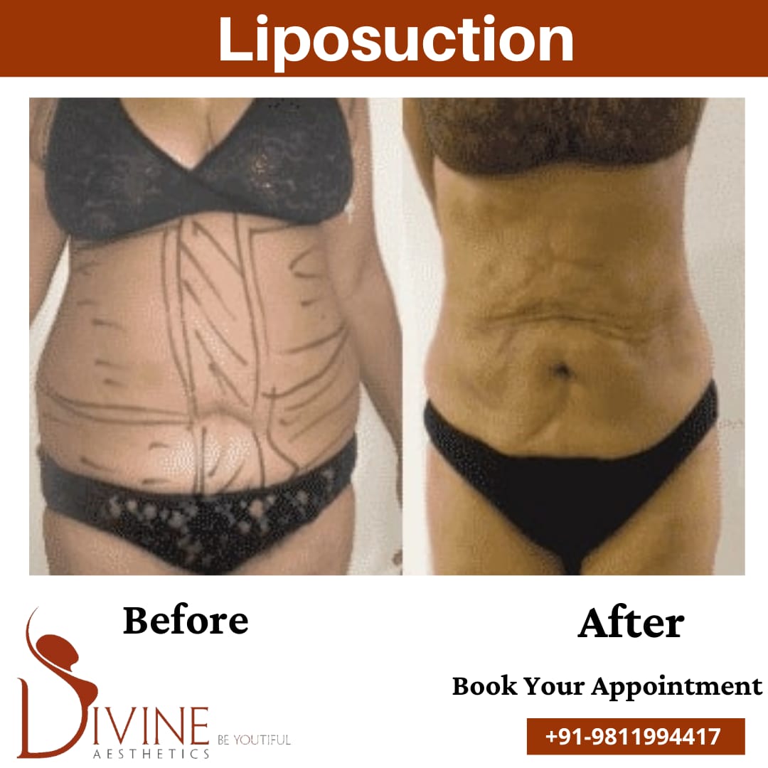 Vaser Liposuction Surgery result