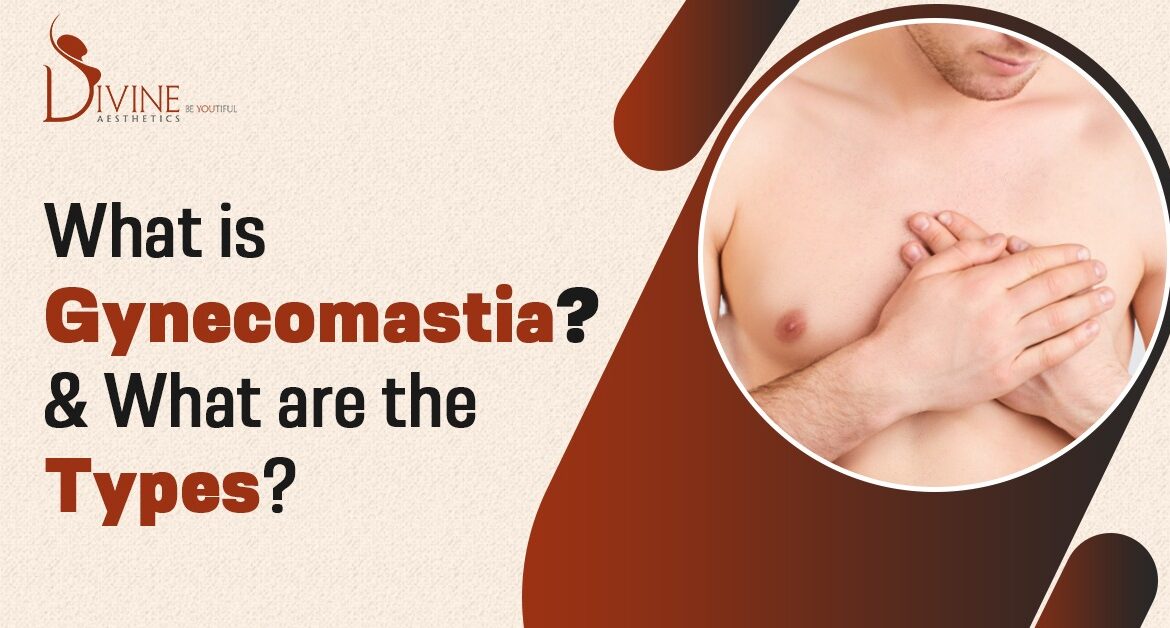 Types of Gynecomastia