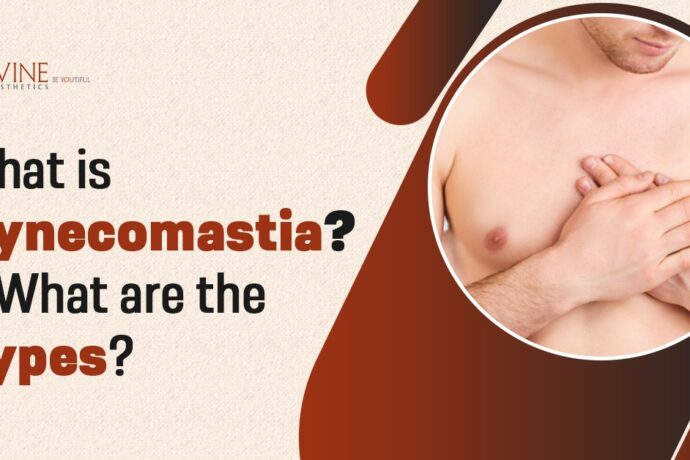 What is Gynecomastia