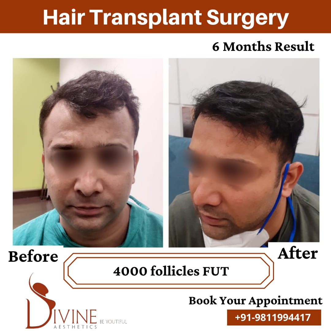 4000 follicles Hair Transplant before after result