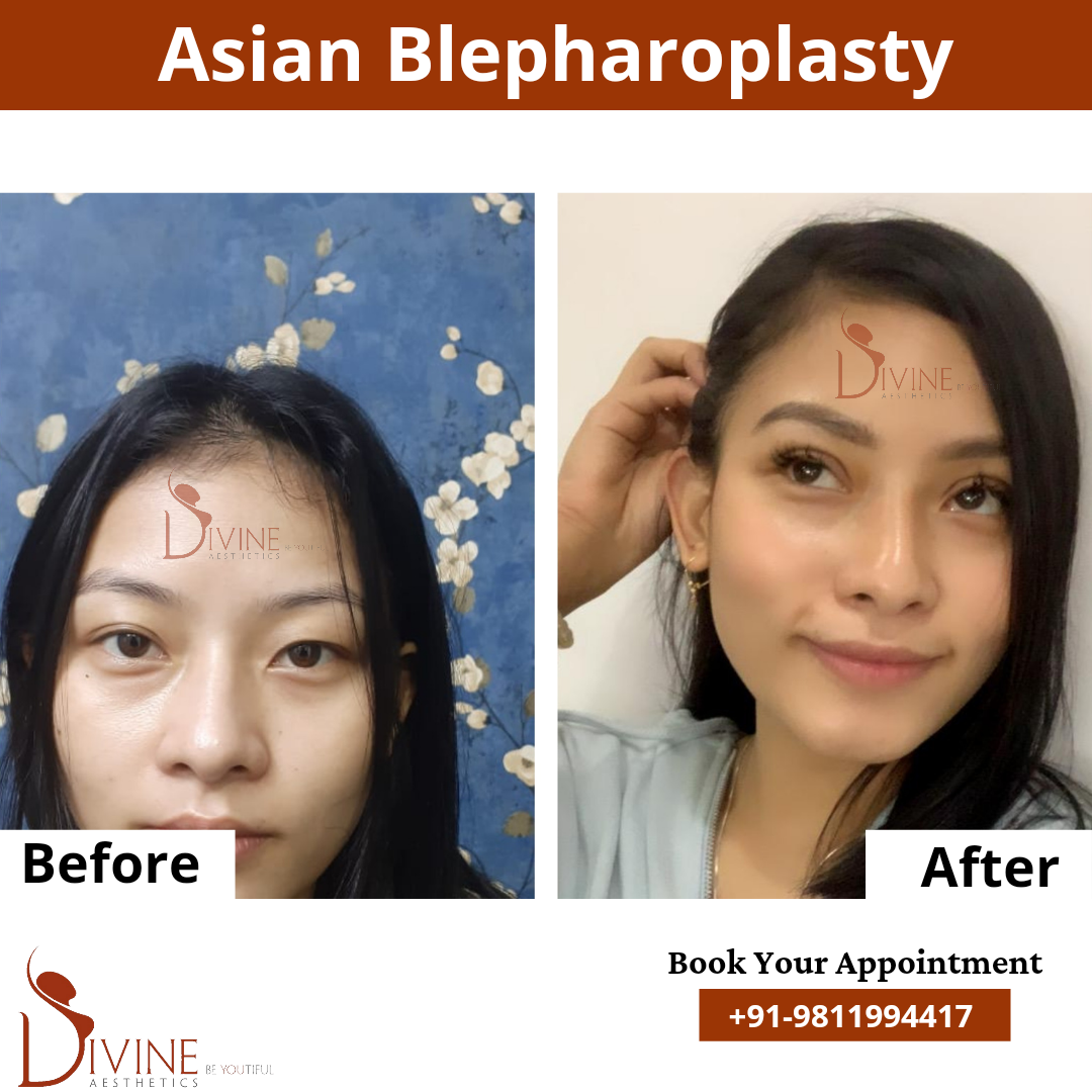asian blepharoplasty before after