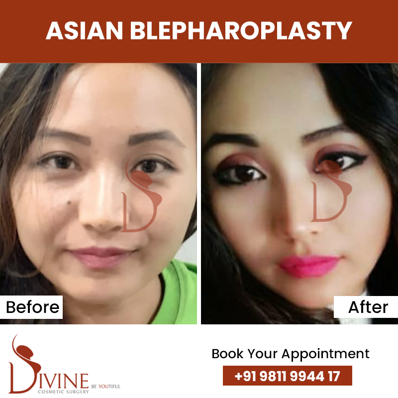asian blepharoplasty before after
