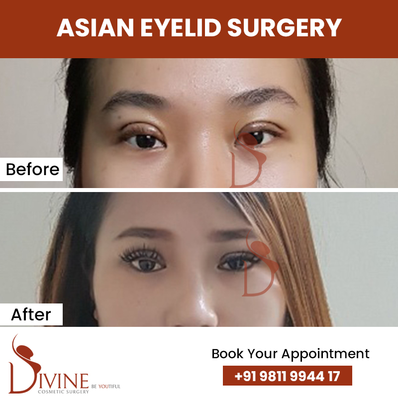 asian eyelid surgery before after