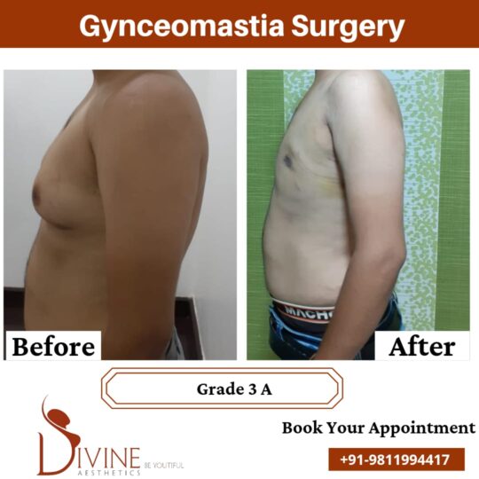 gynecomastia surgery grade 3a