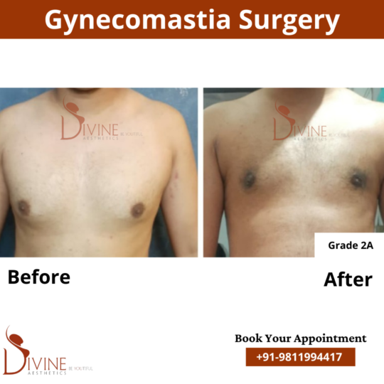 gynecomastia surgery grade 2a