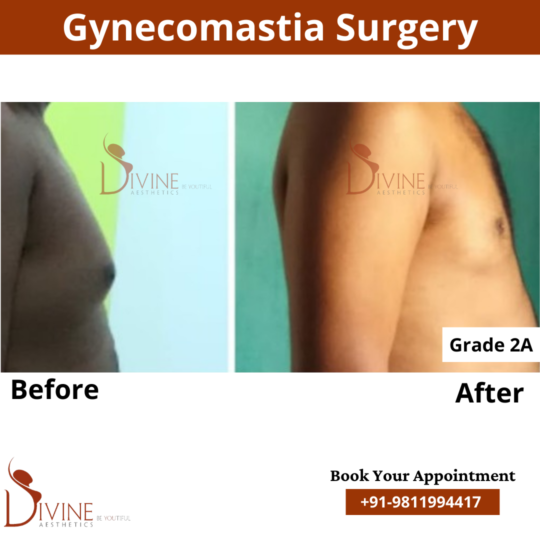 best gynecomastia surgery grade 2a