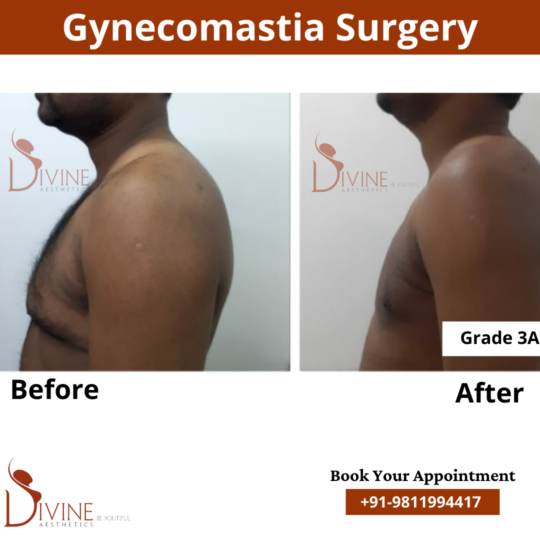 best gynecomastia surgery grade 3a