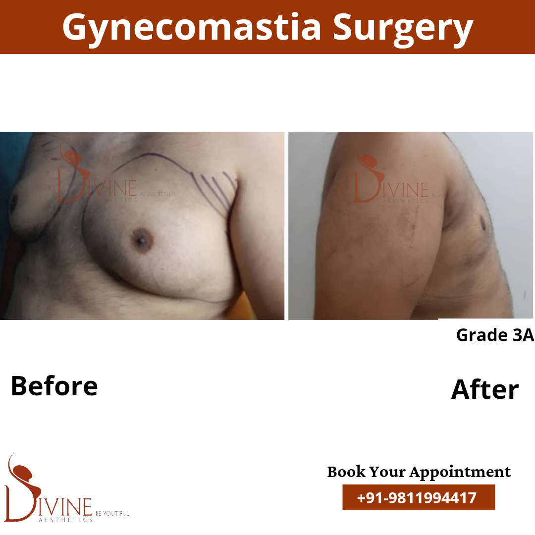 best gynecomastia surgery grade 3a