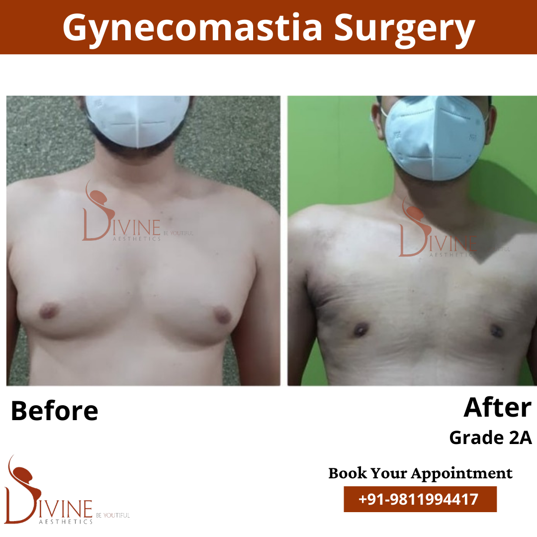 gynecomastia surgery cost in gurgaon